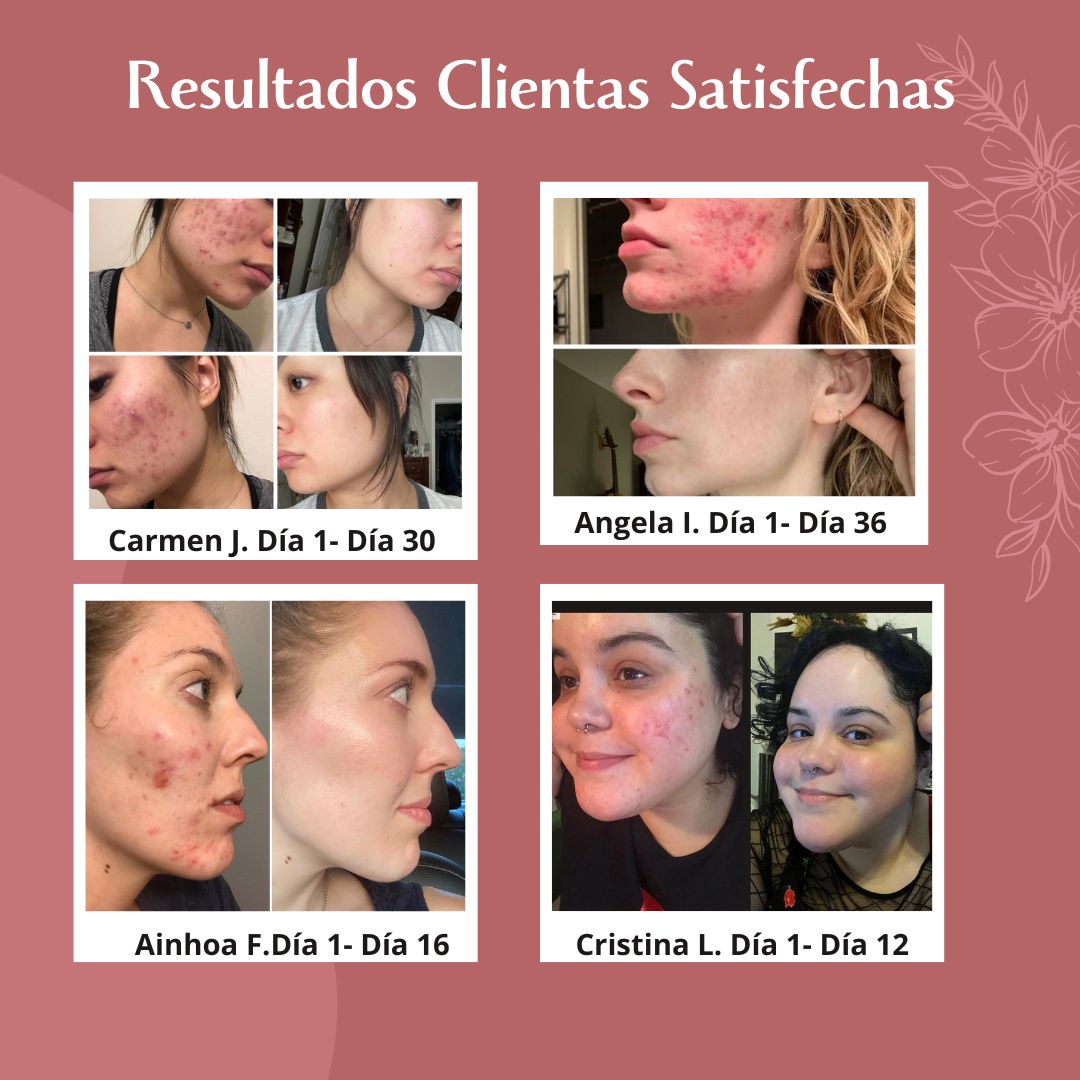 PerfectSkin™ - La Fórmula Única para una Piel Sin Acné ni Manchas
