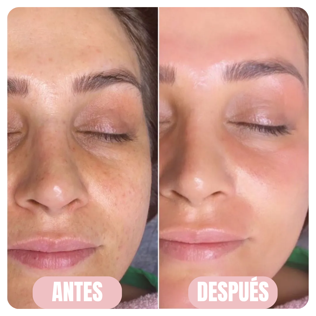 CristalSkin™ Rejuvenece tu piel un 90% desde la primera aplicación — 100% GARANTIZADO