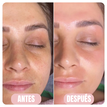 CristalSkin™ Rejuvenece tu piel un 90% desde la primera aplicación — 100% GARANTIZADO