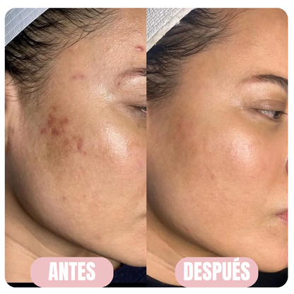 CristalSkin™ Rejuvenece tu piel un 90% desde la primera aplicación — 100% GARANTIZADO